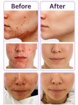 SHEIN Azelaic Acid Cream For Face Acne Cream