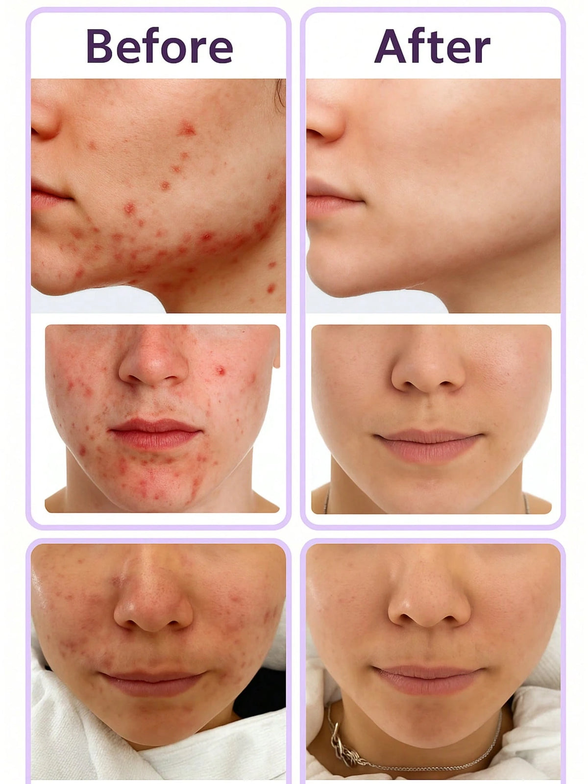 SHEIN Azelaic Acid Cream For Face Acne Cream